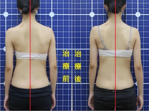 脊聲動 | 脊椎側彎 / 脊柱側彎  矯正成功分享