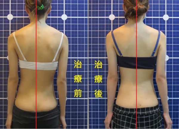 脊聲動 | 脊椎側彎 / 脊柱側彎  矯正成功分享