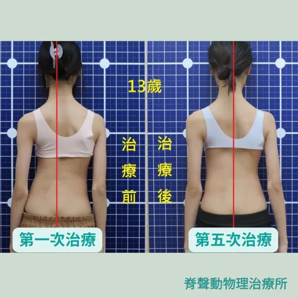脊聲動 | 脊椎側彎 / 脊柱側彎  矯正成功分享