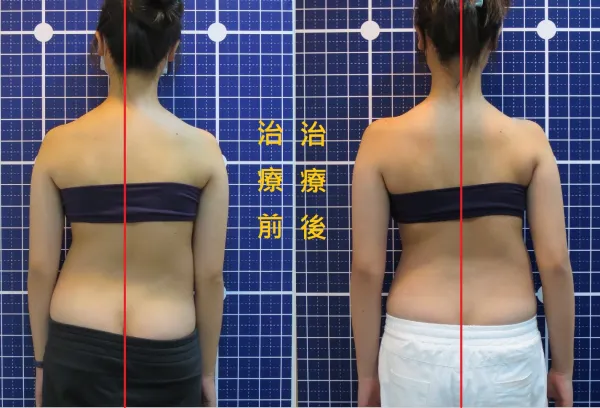 脊聲動 | 脊椎側彎 / 脊柱側彎  矯正成功分享