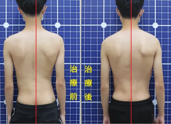 脊聲動 | 脊椎側彎 / 脊柱側彎  矯正成功分享