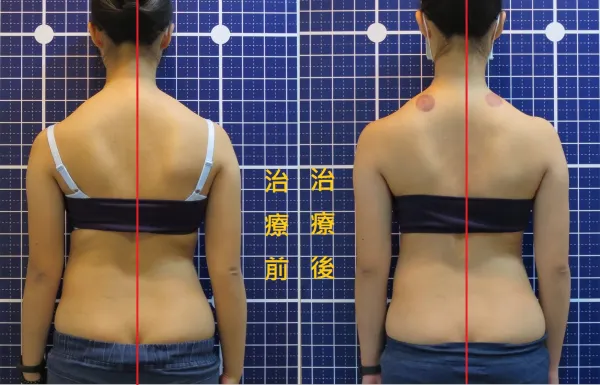 脊聲動 | 脊椎側彎 / 脊柱側彎  矯正成功分享