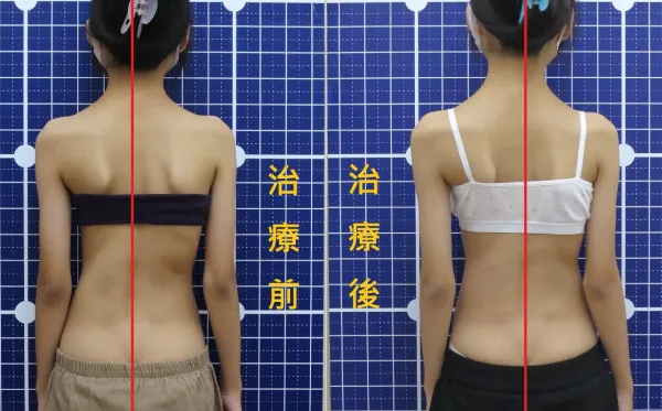 脊聲動 | 脊椎側彎 / 脊柱側彎  矯正成功分享