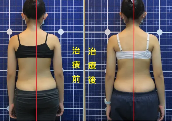 脊聲動 | 脊椎側彎 / 脊柱側彎  矯正成功分享