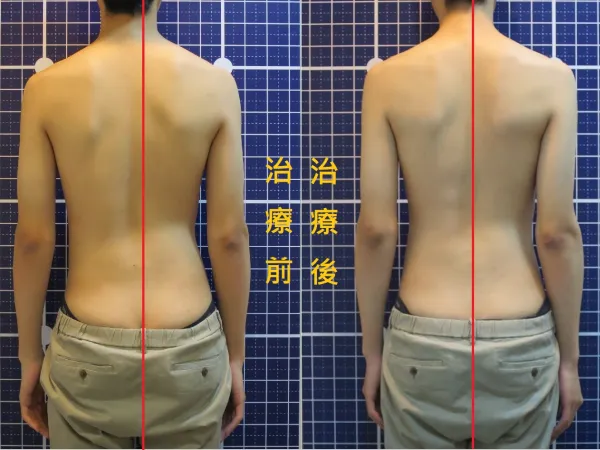 脊聲動 | 脊椎側彎 / 脊柱側彎  矯正成功分享