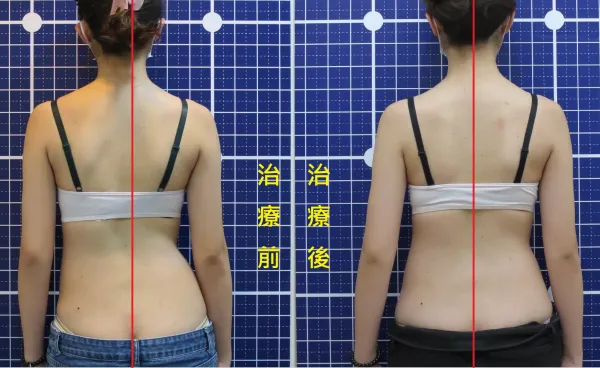 脊聲動 | 脊椎側彎 / 脊柱側彎  矯正成功分享