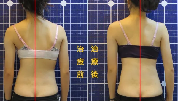 脊聲動 | 脊椎側彎 / 脊柱側彎  矯正成功分享
成年人脊椎側彎還有機會改善嗎?