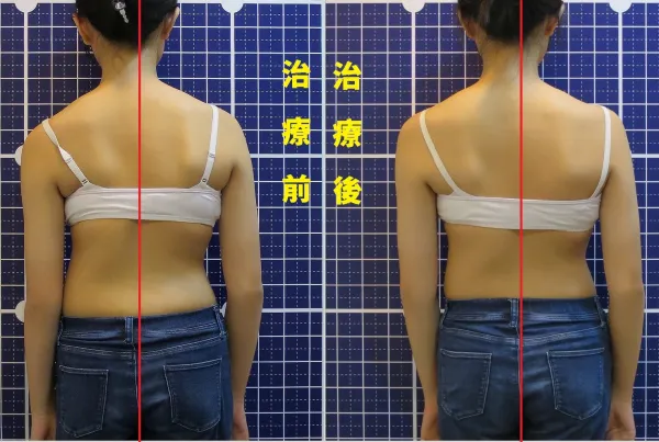 脊聲動 | 脊椎側彎 / 脊柱側彎  矯正成功分享