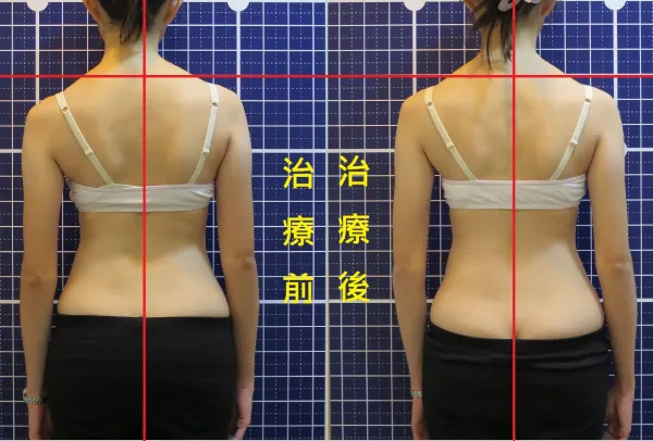 脊聲動 | 脊椎側彎 / 脊柱側彎  矯正成功分享