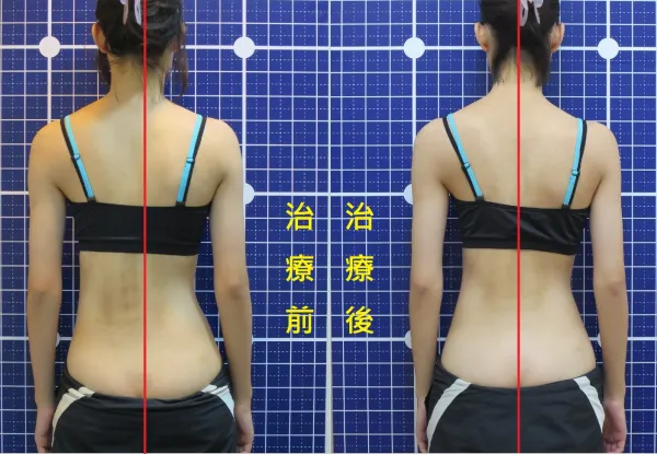 脊聲動 | 脊椎側彎 / 脊柱側彎  矯正成功分享