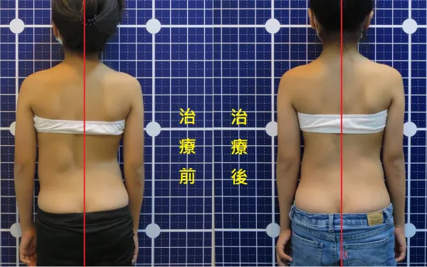 脊聲動 | 脊椎側彎 / 脊柱側彎  矯正成功分享