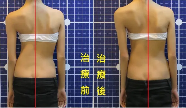 脊聲動 | 脊椎側彎 / 脊柱側彎  矯正成功分享