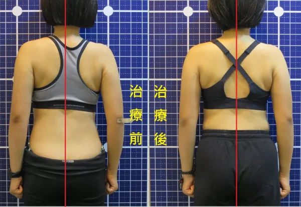 脊椎脊聲動 | 脊椎側彎 / 脊柱側彎  矯正成功分享