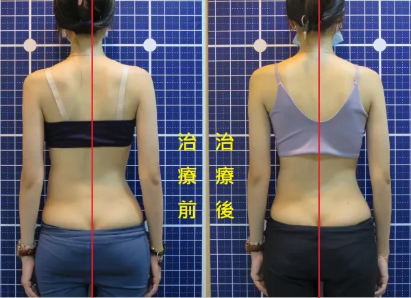 脊聲動 | 脊椎側彎 / 脊柱側彎  矯正成功分享