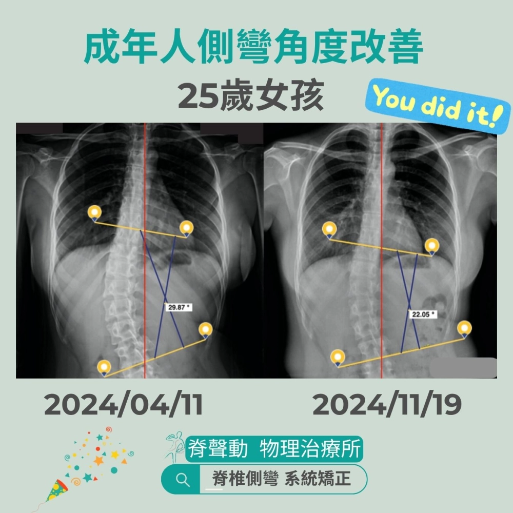 脊聲動 | 脊椎側彎 / 脊柱側彎  矯正成功分享