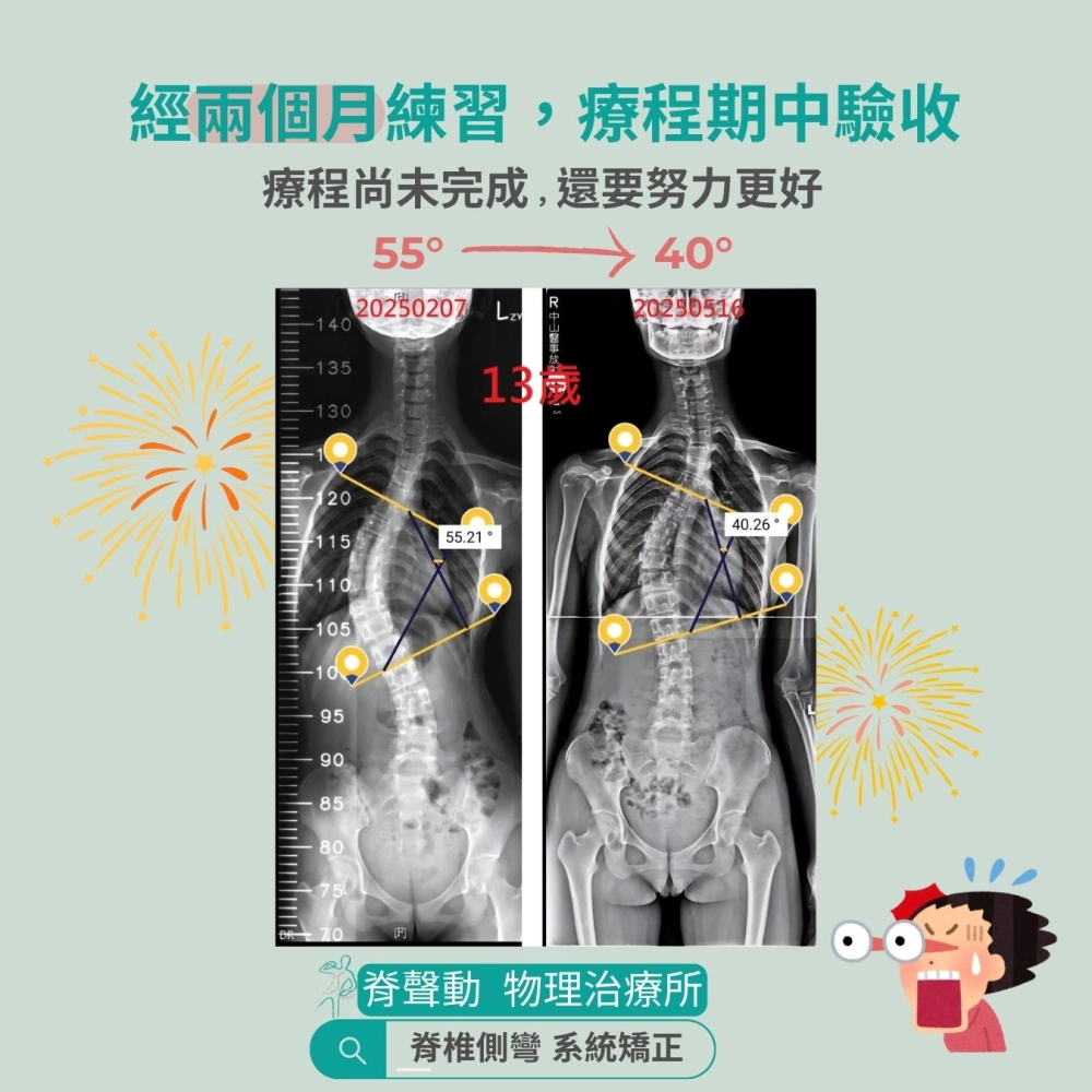 脊聲動 | 脊椎側彎 / 脊柱側彎  矯正成功分享