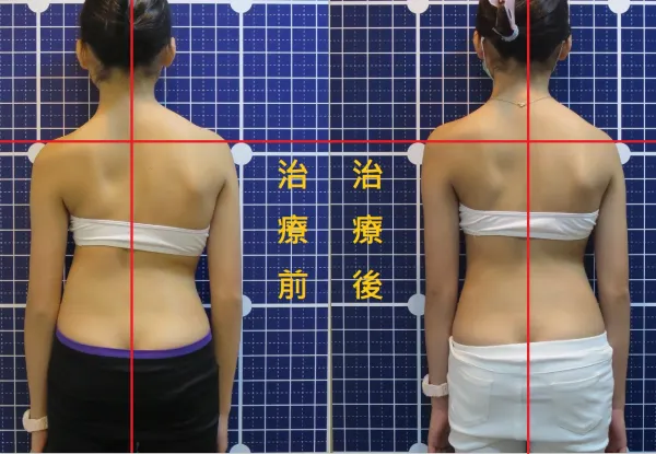 脊聲動 | 脊椎側彎 / 脊柱側彎  矯正成功分享