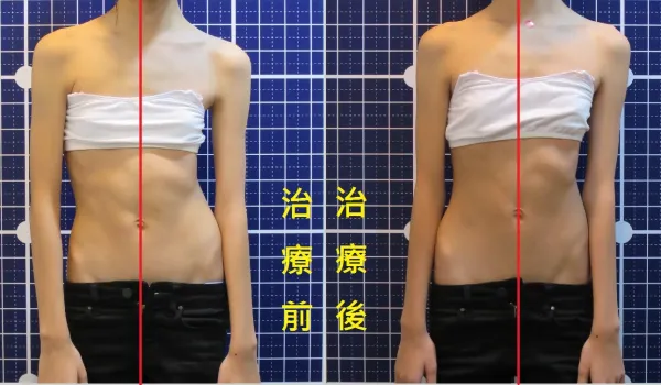 脊聲動 | 脊椎側彎 / 脊柱側彎  矯正成功分享