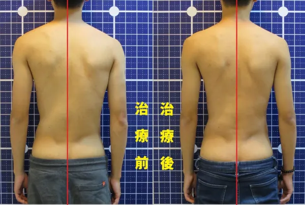 脊聲動 | 脊椎側彎 / 脊柱側彎  矯正成功分享