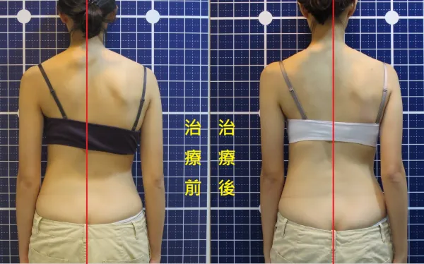 脊聲動 | 脊椎側彎 / 脊柱側彎  矯正成功分享