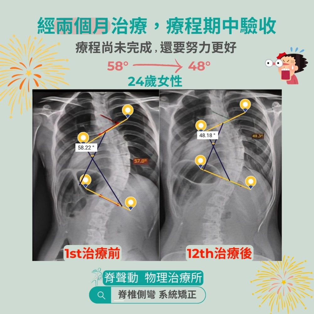 脊聲動 | 脊椎側彎 / 脊柱側彎  矯正成功分享