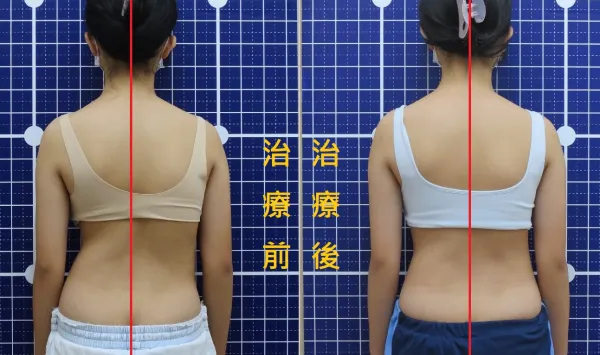 脊聲動 | 脊椎側彎 / 脊柱側彎  矯正成功分享