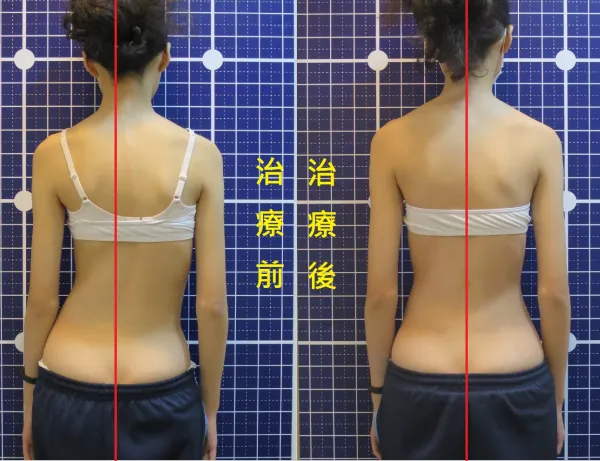 脊聲動 | 脊椎側彎 / 脊柱側彎  矯正成功分享
