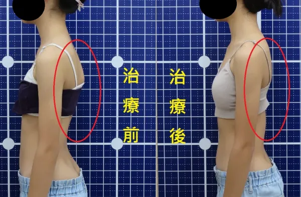 脊聲動 | 脊椎側彎 / 脊柱側彎  矯正成功分享