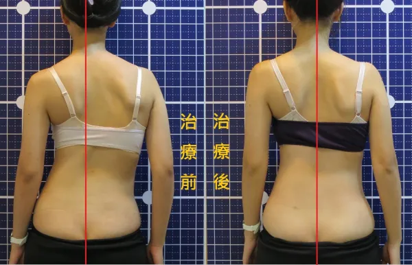 脊聲動 | 脊椎側彎 / 脊柱側彎  矯正成功分享