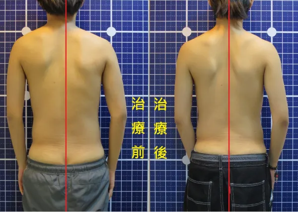 脊聲動 | 脊椎側彎 / 脊柱側彎  矯正成功分享