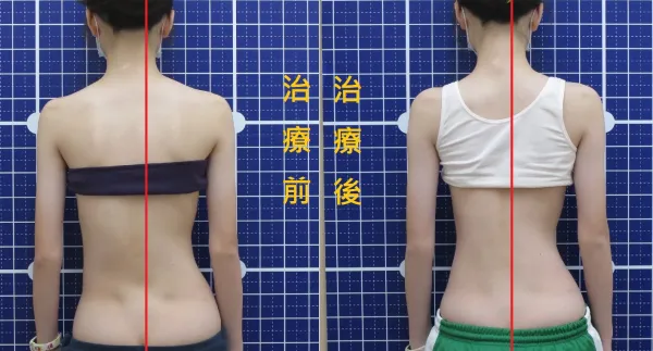 脊聲動 | 脊椎側彎 / 脊柱側彎  矯正成功分享