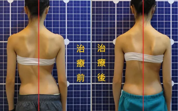 脊聲動 | 脊椎側彎 / 脊柱側彎  矯正成功分享