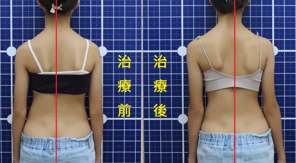 脊聲動 | 脊椎側彎 / 脊柱側彎  矯正成功分享