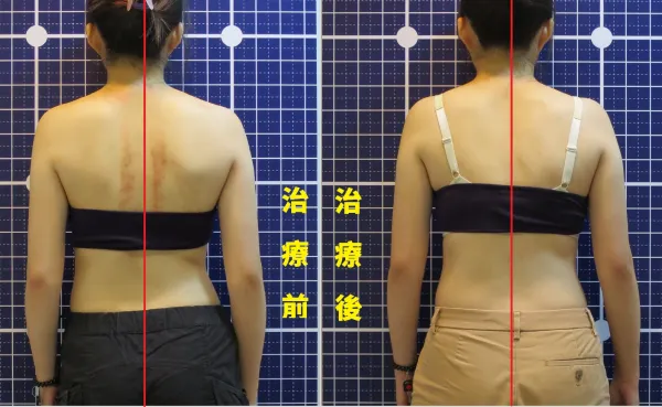 脊聲動 | 脊椎側彎 / 脊柱側彎  矯正成功分享