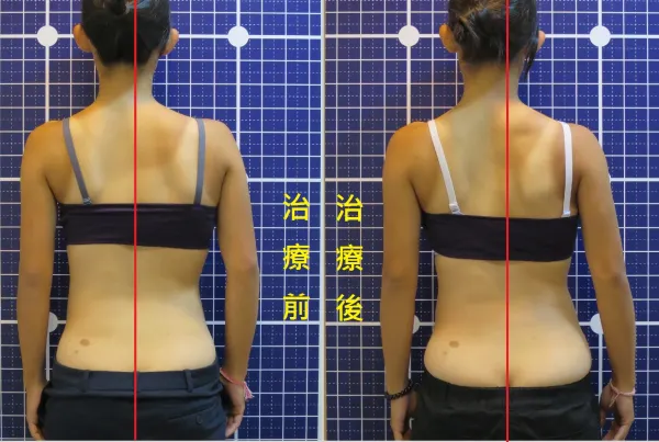 脊聲動 | 脊椎側彎 / 脊柱側彎  矯正成功分享