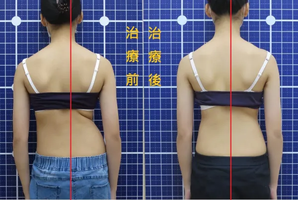 脊聲動 | 脊椎側彎 / 脊柱側彎  矯正成功分享