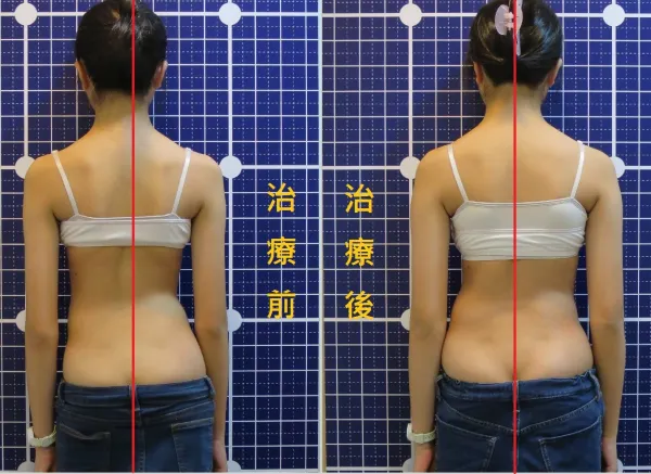 脊聲動 | 脊椎側彎 / 脊柱側彎  矯正成功分享