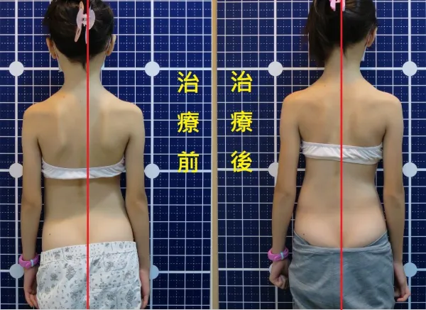 脊聲動 | 脊椎側彎 / 脊柱側彎  矯正成功分享