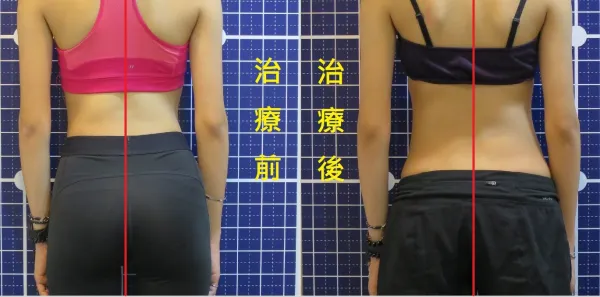 脊聲動 | 脊椎側彎 / 脊柱側彎  矯正成功分享