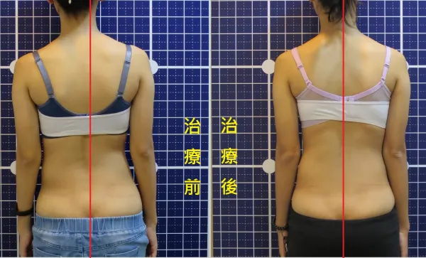 脊聲動 | 脊椎側彎 / 脊柱側彎  矯正成功分享