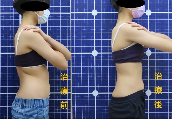 脊聲動 | 脊椎側彎 / 脊柱側彎  矯正成功分享