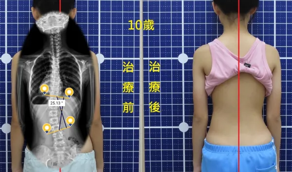 脊聲動 | 脊椎側彎 / 脊柱側彎  矯正成功分享