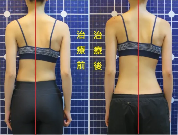 脊聲動 | 脊椎側彎 / 脊柱側彎  矯正成功分享