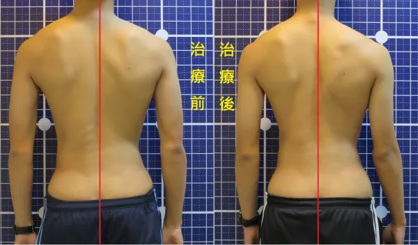 脊聲動 | 脊椎側彎 / 脊柱側彎  矯正成功分享