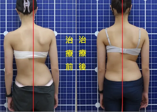 脊聲動 | 脊椎側彎 / 脊柱側彎  矯正成功分享
