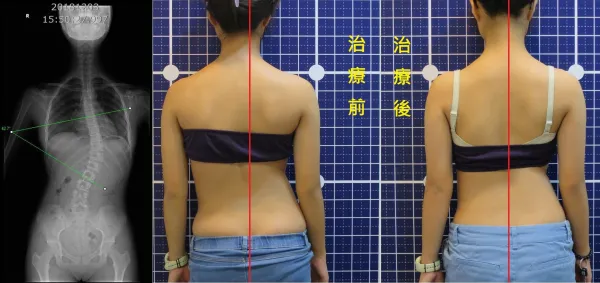 脊聲動 | 脊椎側彎 / 脊柱側彎  矯正成功分享