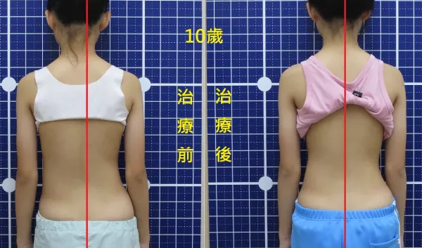 脊聲動 | 脊椎側彎 / 脊柱側彎  矯正成功分享