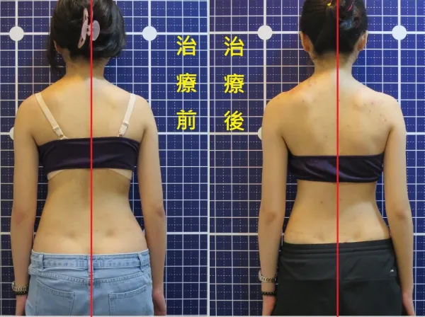脊聲動 | 脊椎側彎 / 脊柱側彎  矯正成功分享