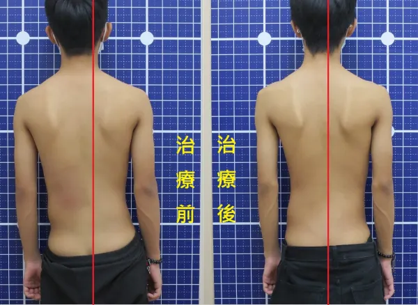 脊聲動 | 脊椎側彎 / 脊柱側彎  矯正成功分享
