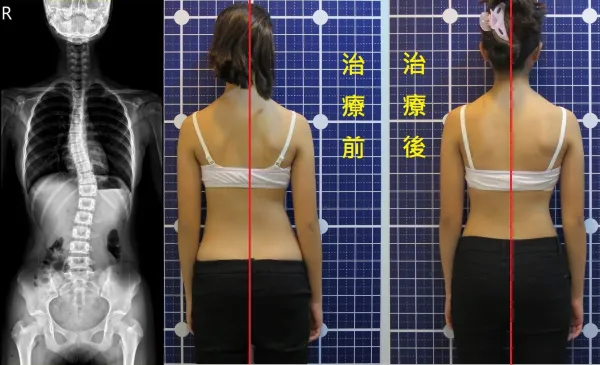 脊聲動 | 脊椎側彎 / 脊柱側彎  矯正成功分享